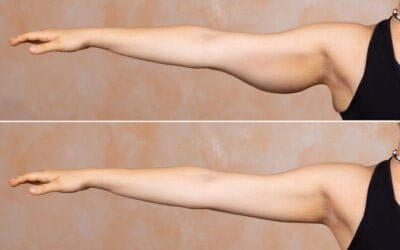 Renuvion - Fettsugning med Skintightening