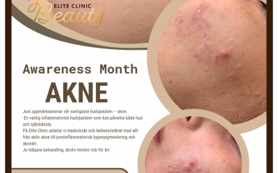 Akne och Akneärr – Hudläkare och Hudterapeuter