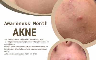 Akne och Akneärr – Hudläkare och Hudterapeuter