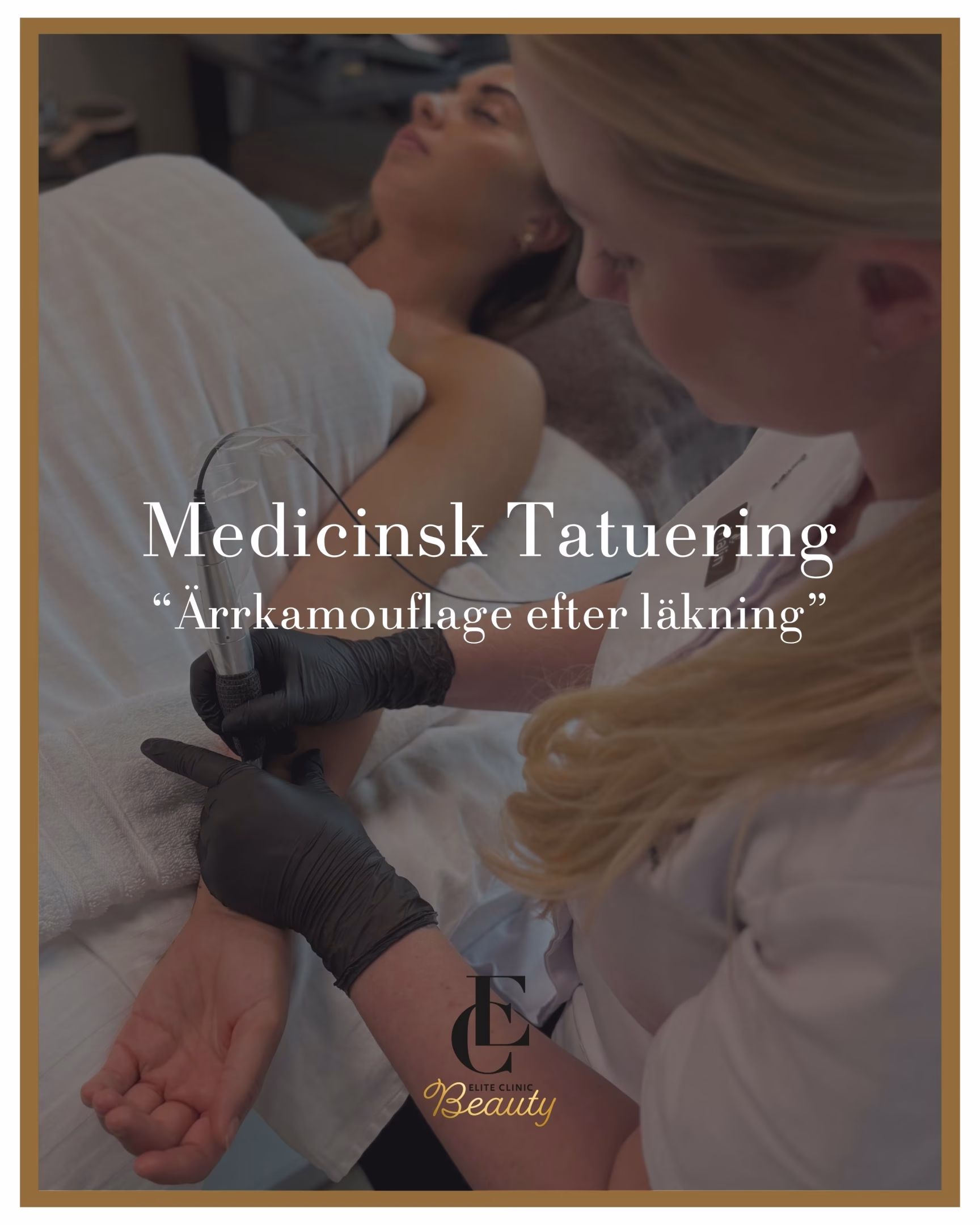 Medicinsk tatuering för självskadeärr – Ärrkamouflage efter läkning.
