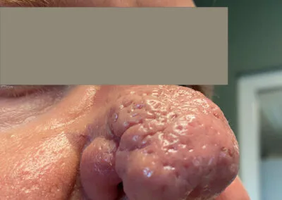 Rhinophyma
