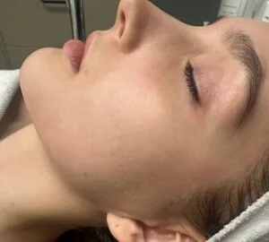 Ärrbehandling av akneärr - Efter