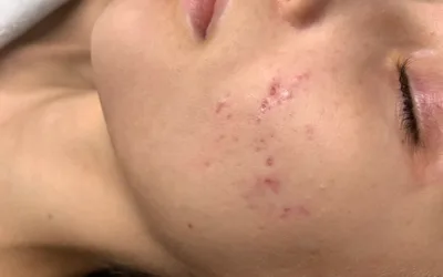 Acne scar treatment - Before