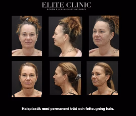 Ansikte Halsplastik med permanent tråd och fettsugning hals.