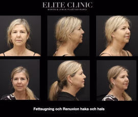 Ansikte Fettsugning och Renuvion haka och hals