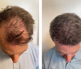 Hårtransplantation före- och efterbild vid 6-månaderskontrollen. Slutkontroll vid 12 mån. Hårtransplantation före- och efterbild