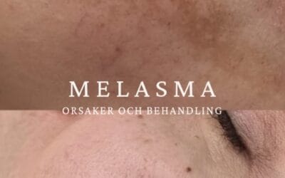 Varför får man melasma?