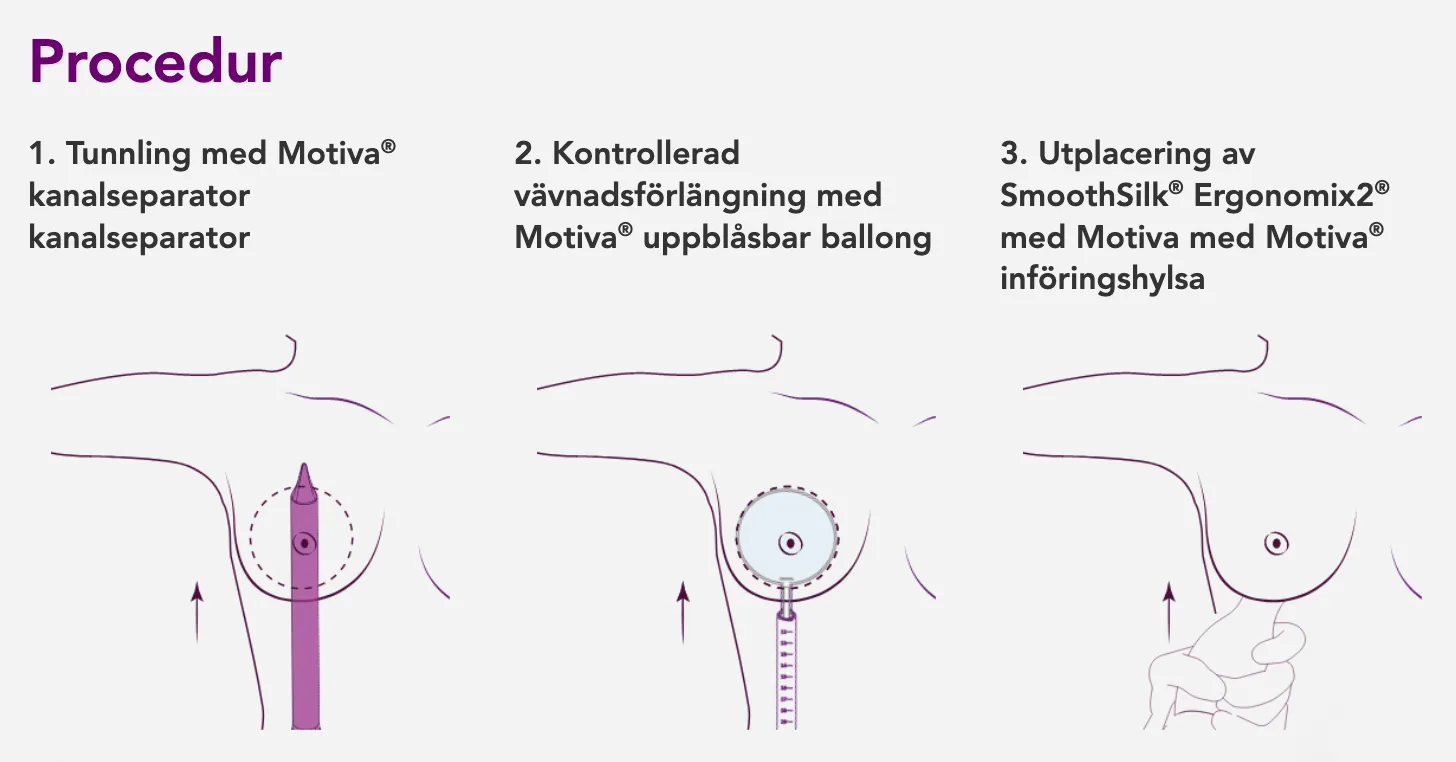 Erhaltene Brustvergrößerung