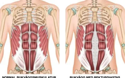 Split abdominal muscles - Diastasis recti